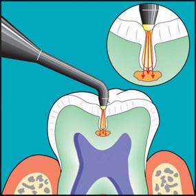 Diagram of lasers used for cavity detection
